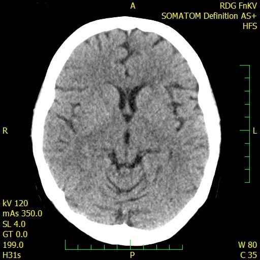 Normální CT mozku - snímek poskytnut Radiodiagnostickou klinikou FNKV a 3. LF UK (MUDr. Marek Laboš)